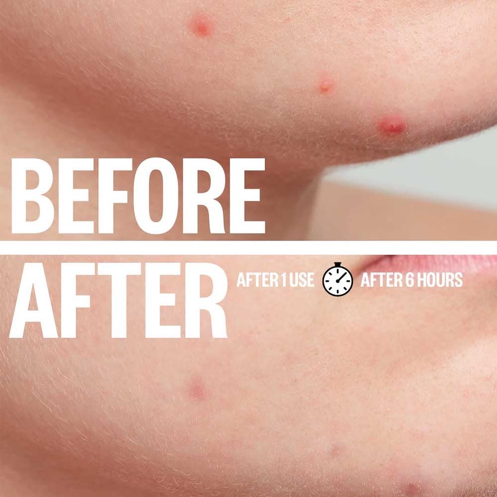 a.l.m. Magical Patch (3) Hydrocolloid pimple patches. These ultra thin & translucent hydrocolloid adhesive covers and absorb unwanted pimples. Parches Para Acne for skincare.