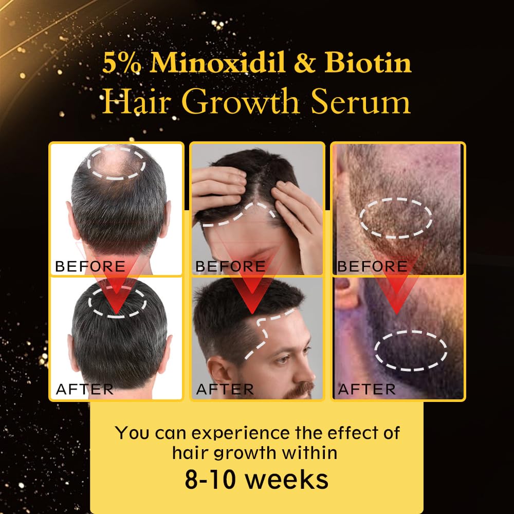 5% Minoxidil Hair Regrowth Oil for Men and Women – Extra Strength Topical Serum for Hair Loss, Promotes Thicker, Healthier Hair and Beard Growth Kit, 2.11 fl.oz