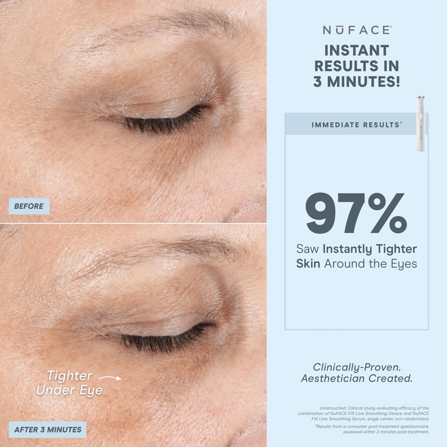 NuFACE FIX Line Smoothing Starter Kit - FDA Cleared Microcurrent Device + Serum Activator for On-The-Go Treatment of Forehead Lines, Crow's Feet, Under Eyes, Smile & Fuller-Looking Lips