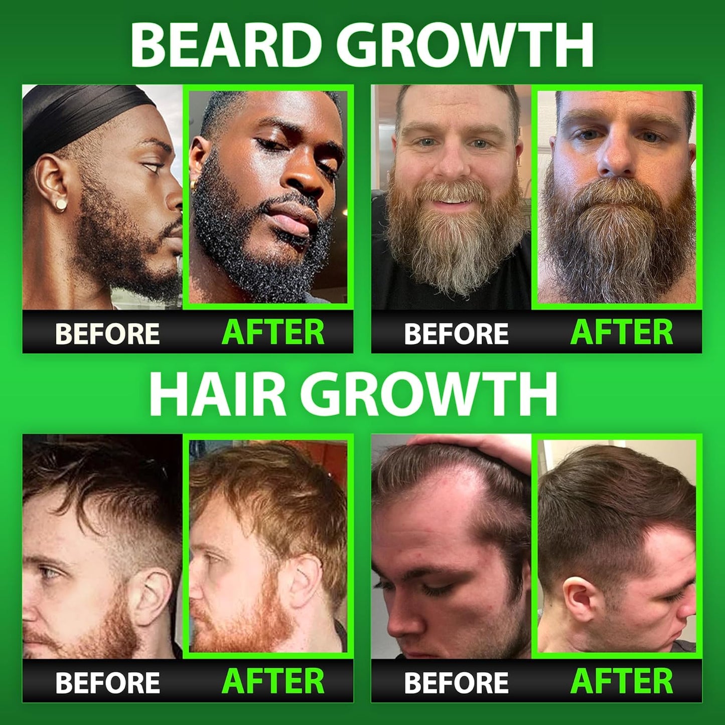 Beard Growth Kit w/GROW Beard Oil for Men (Mens Beard Growth Serum) + Biotin Gummies Beard Growth Vitamins & Hair Growth Vitamins for Men
