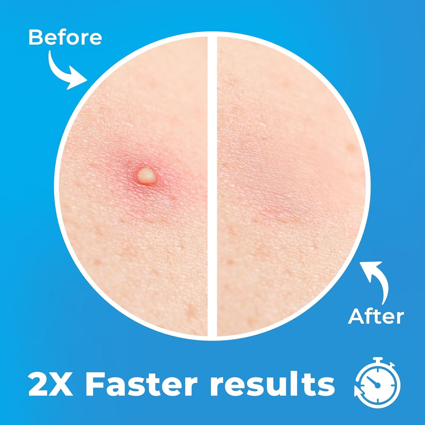 Pimple Patches for Face (120 Patches), Hydrocolloid Acne Patches with Tea Tree Oil, Pimple Patch Pimple Stickers - Hydrocolloid Patch Acne Dots - Acne Pimple Patches For Face - Zit Patches